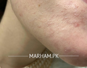 Small Tiny Bimps Full Face