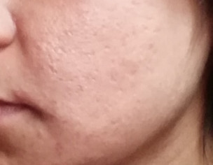Acne Scars