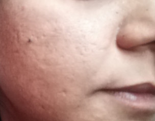 Acne Scars