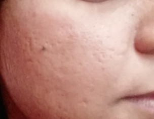 Acne Scars