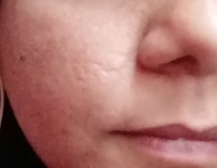 Acne Scars