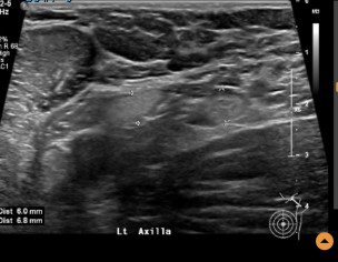 Inflammation? Cancer?