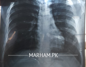 X Ray Breathing Issue