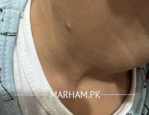 Mumps On Body