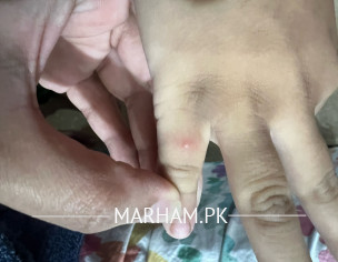 Mumps On Body