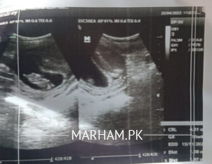 Pregnancyy