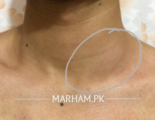 Neck Swelling