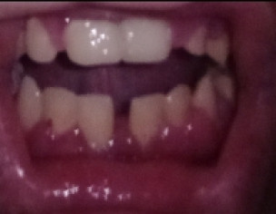 Bottom Teeth Gap