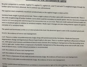 L1 ,2 Disc Herniated 