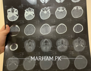 Baby Head Related Problems 