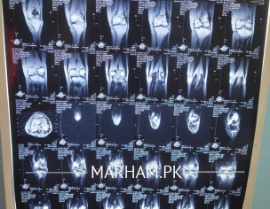 Plate Removal From Tibia