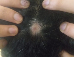 Skin Problem  Hair Fall