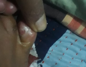 Fingers Infection 
