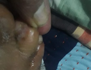 Fingers Infection 