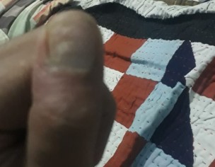 Fingers Infection 