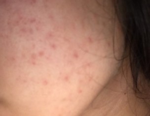 Acne 