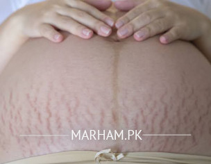 Stretch Marks Body Pain