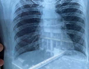 Vomitting For Last 2 Months