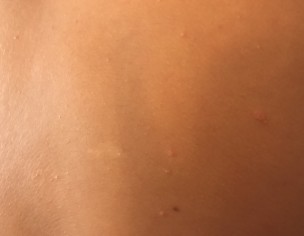 Strange Pimples 