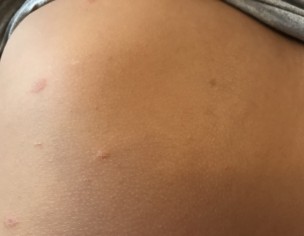 Strange Pimples 