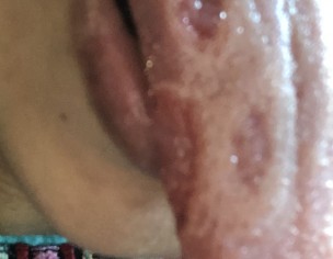 Tongue Burning Sensation