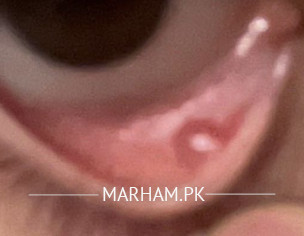 Eye Cyst Or A Bump