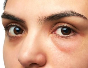 Under Eye Bags