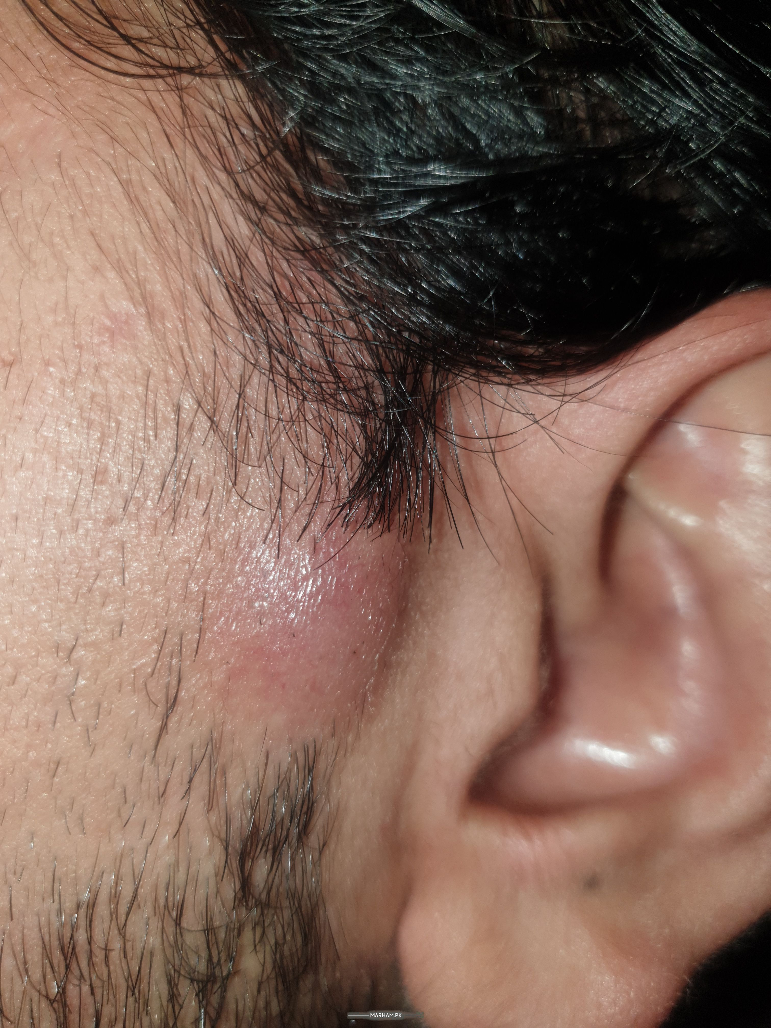 folliculitis scalp