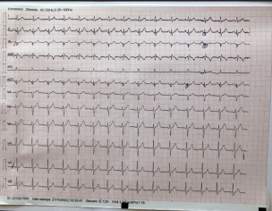 ECG Interpretation