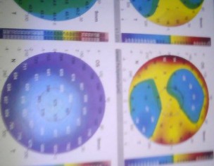 Prevention: Glaucoma