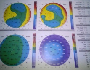 Prevention: Glaucoma