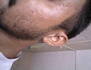 Pimples Scars , Face Problem