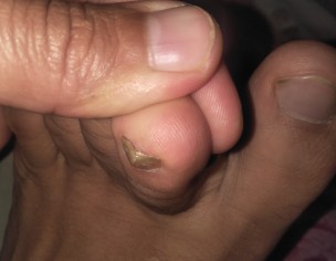 Nail Problem