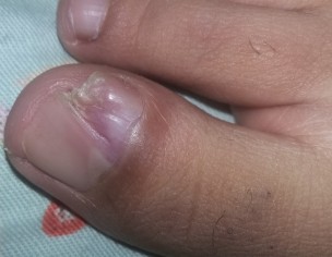 Nail Problem