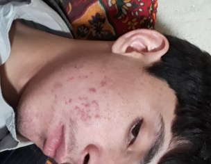 Acnes Pimples 