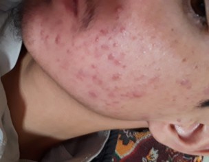 Acnes Pimples 