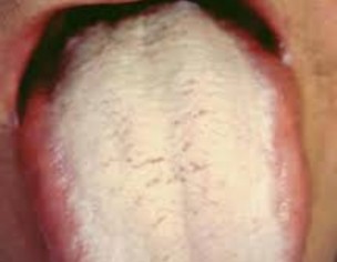 Tongue White