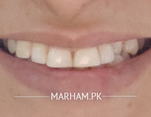 Teeth/uneven Teeth