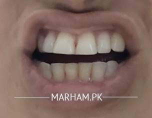 Teeth/uneven Teeth