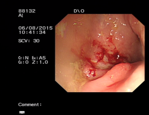 Colon Ulcer