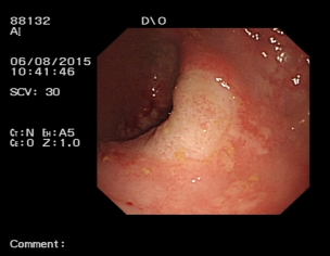 Colon Ulcer