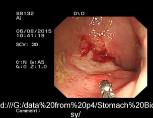 Colon Ulcer