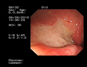 Colon Ulcer