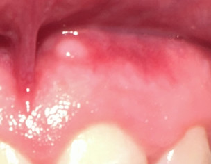 Hard Small White Bump