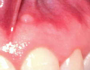 Hard Small White Bump