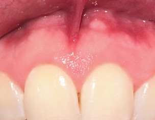 Hard Small White Bump