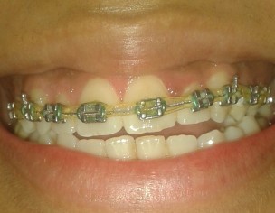 Open-Bite, Midline Misalignment