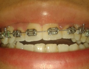 Open-Bite, Midline Misalignment