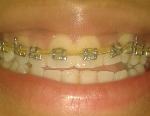 Open-Bite, Midline Misalignment