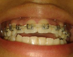 Open-Bite, Midline Misalignment